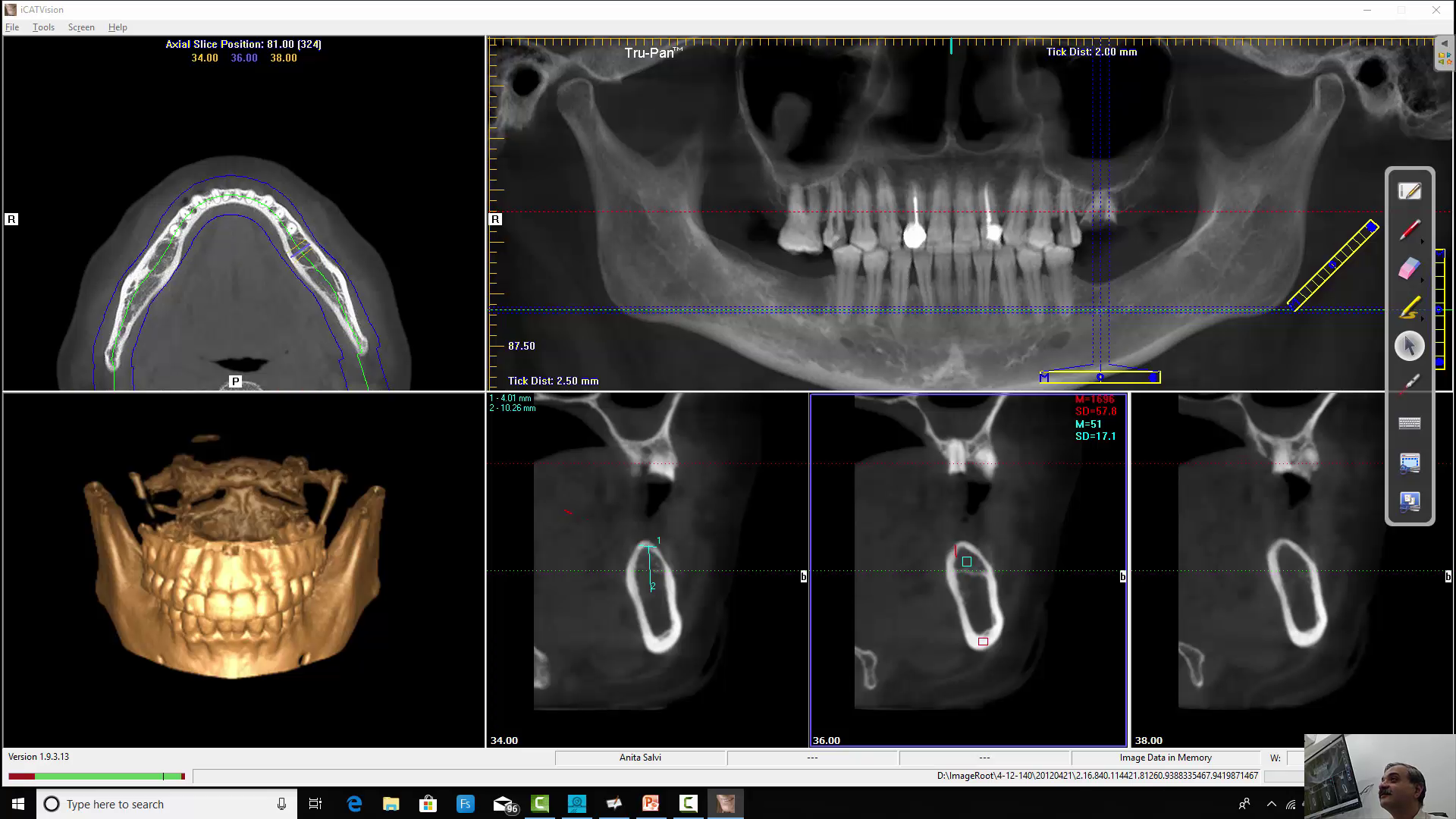 OCCLUSION AND FMR